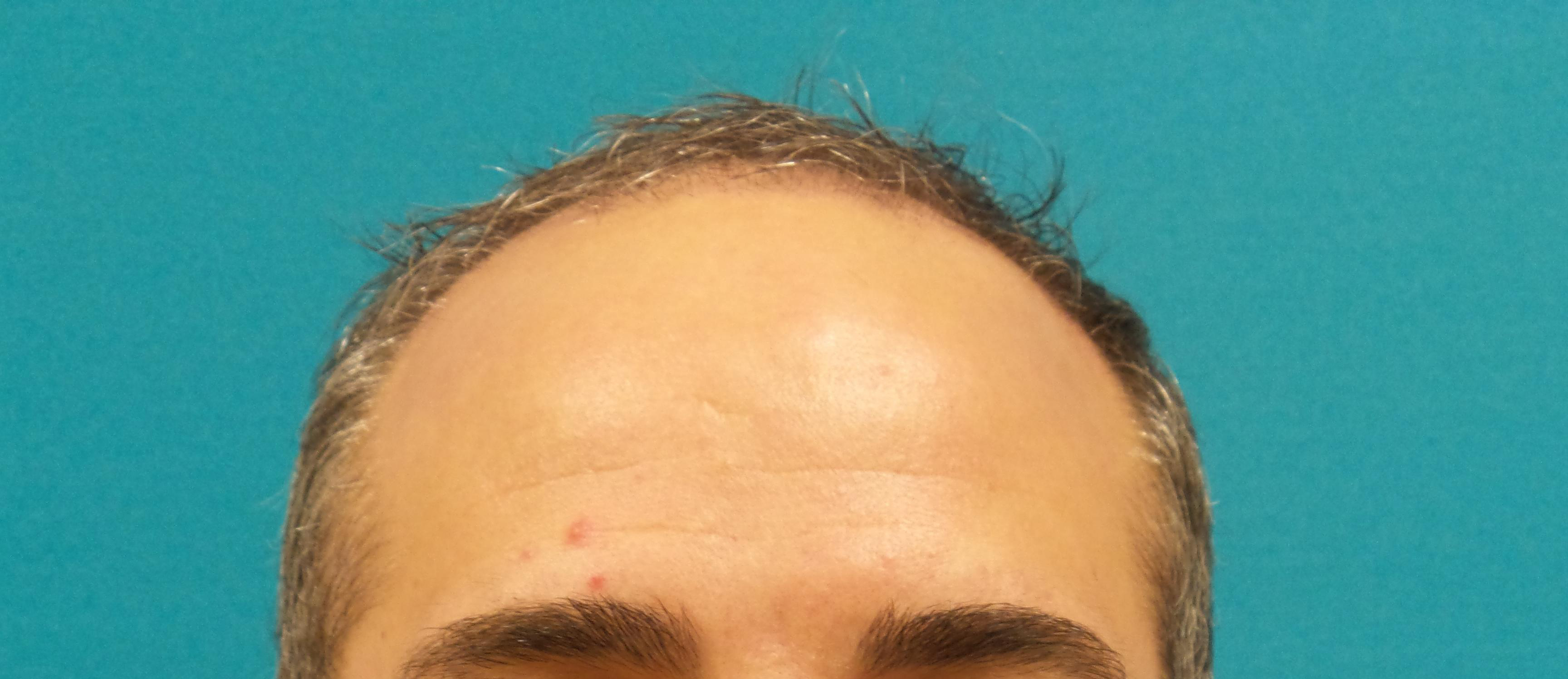 Hair Transplant Before and After | Princeton Plastic Surgeons