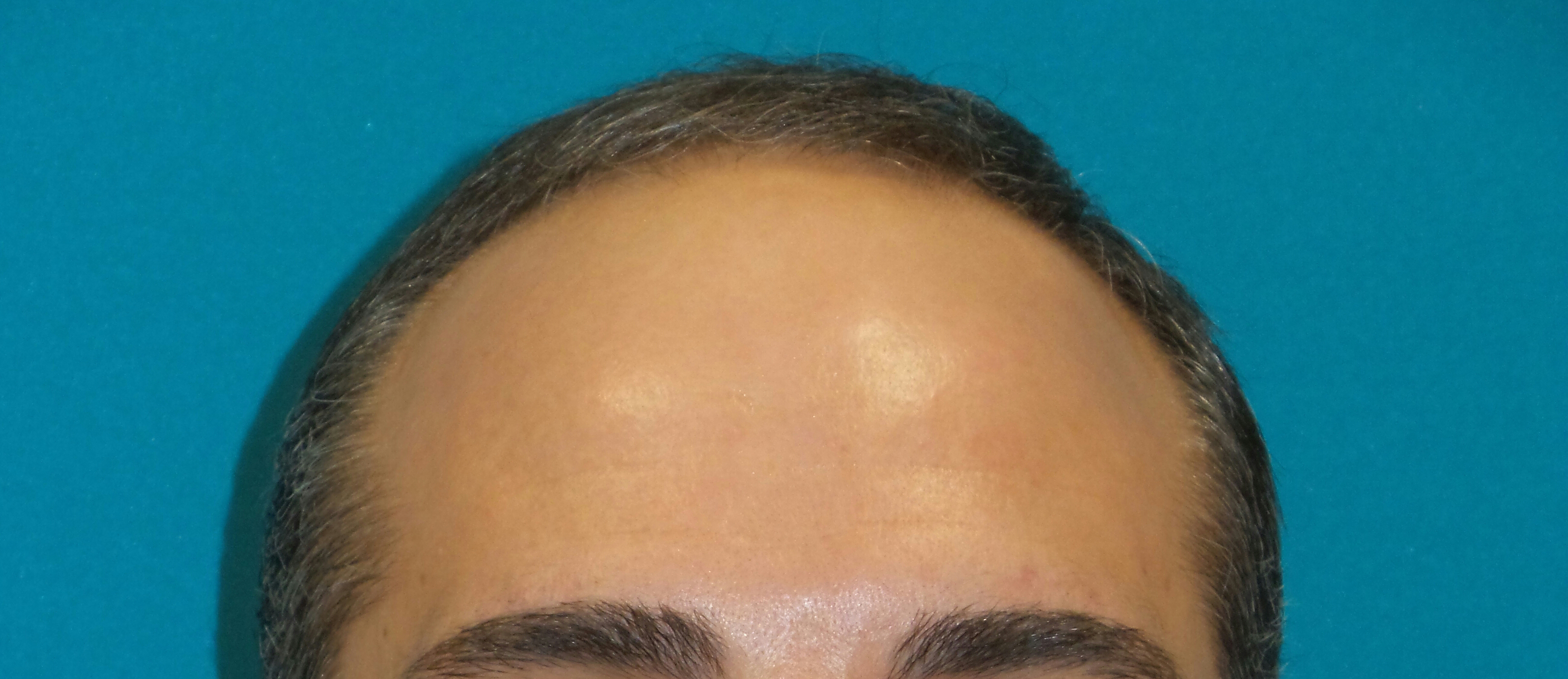 Hair Transplant Before and After | Princeton Plastic Surgeons