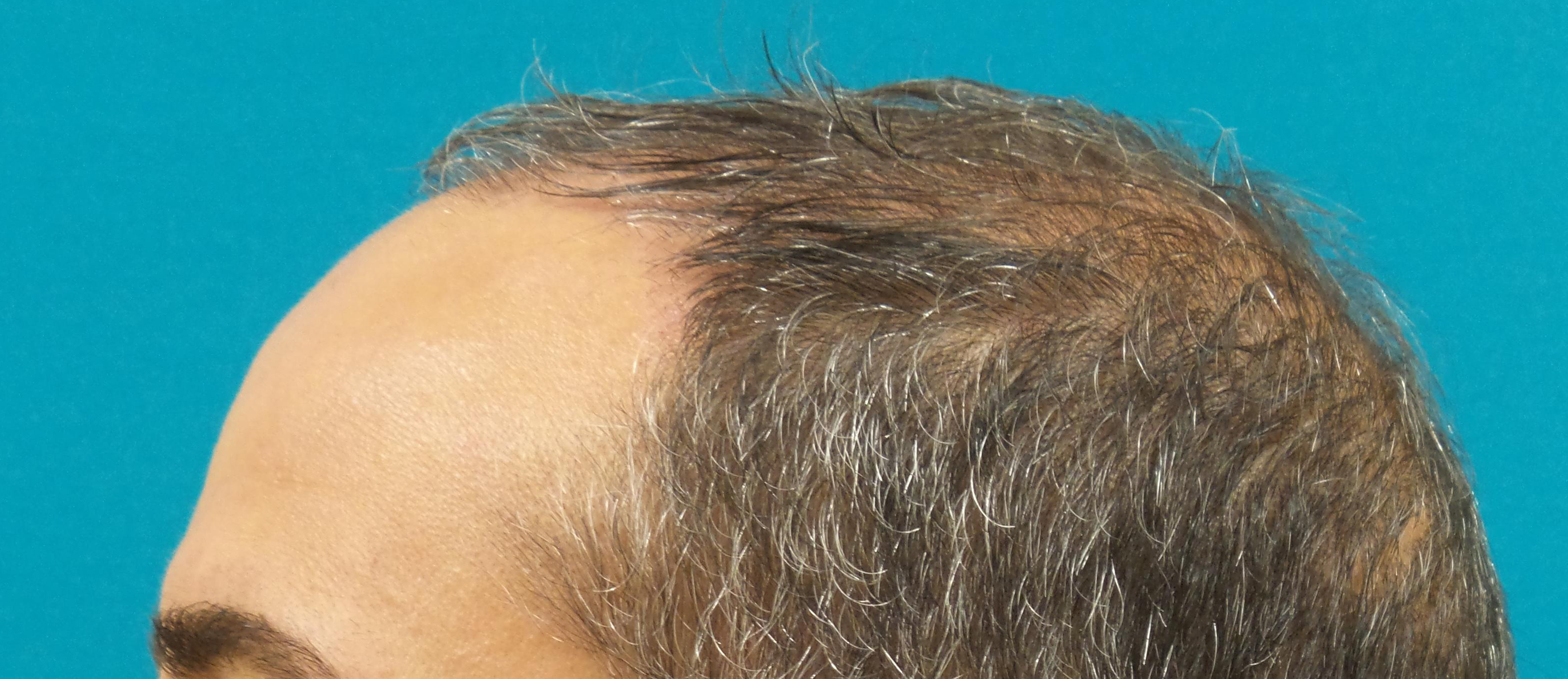 Hair Transplant Before and After | Princeton Plastic Surgeons