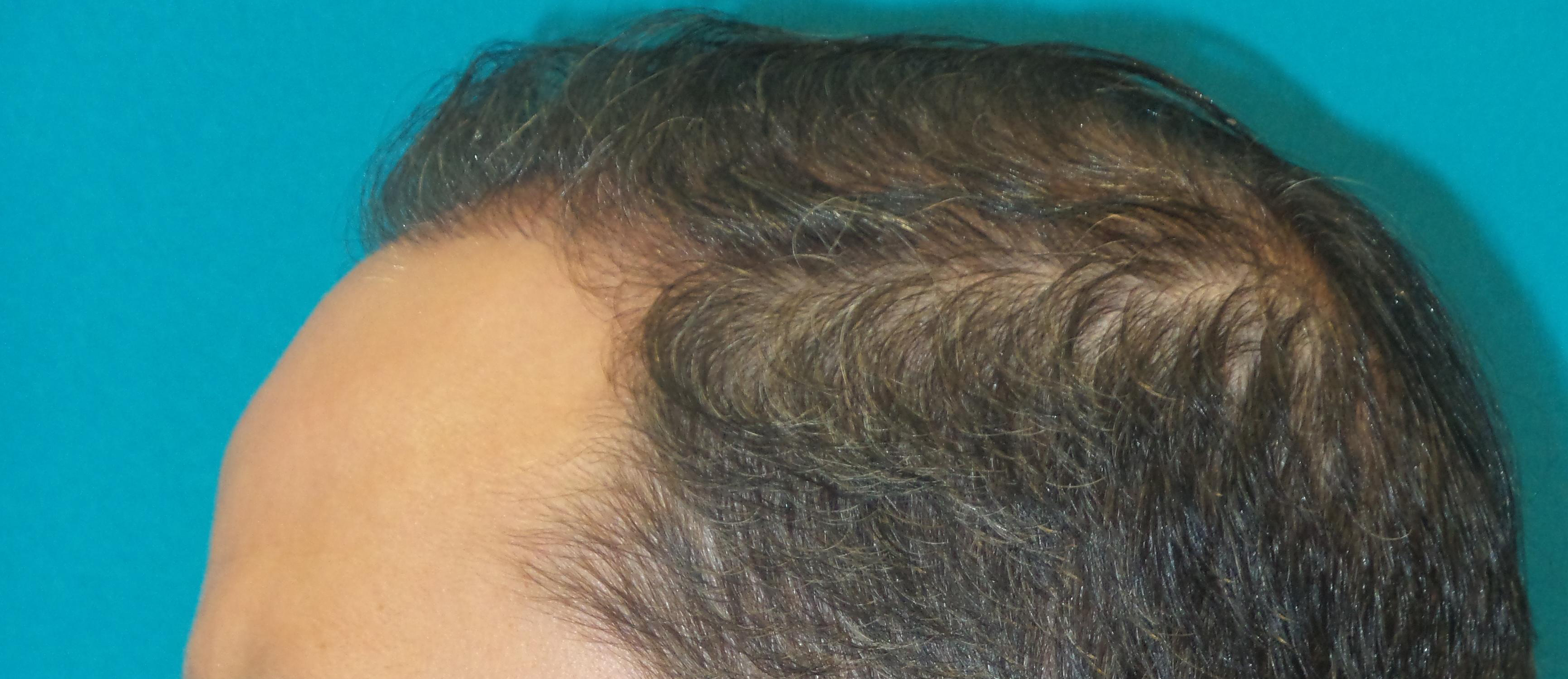 Hair Transplant Before and After | Princeton Plastic Surgeons