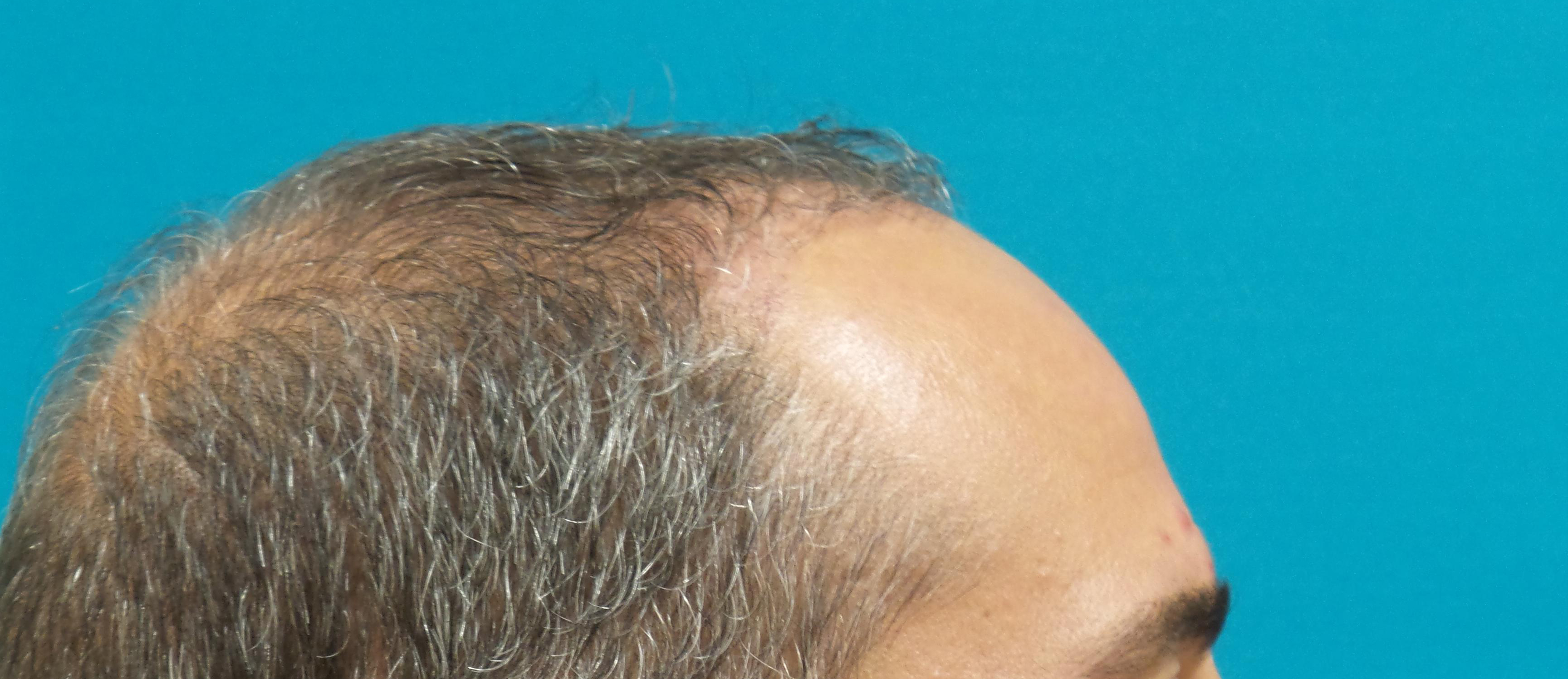 Hair Transplant Before and After | Princeton Plastic Surgeons