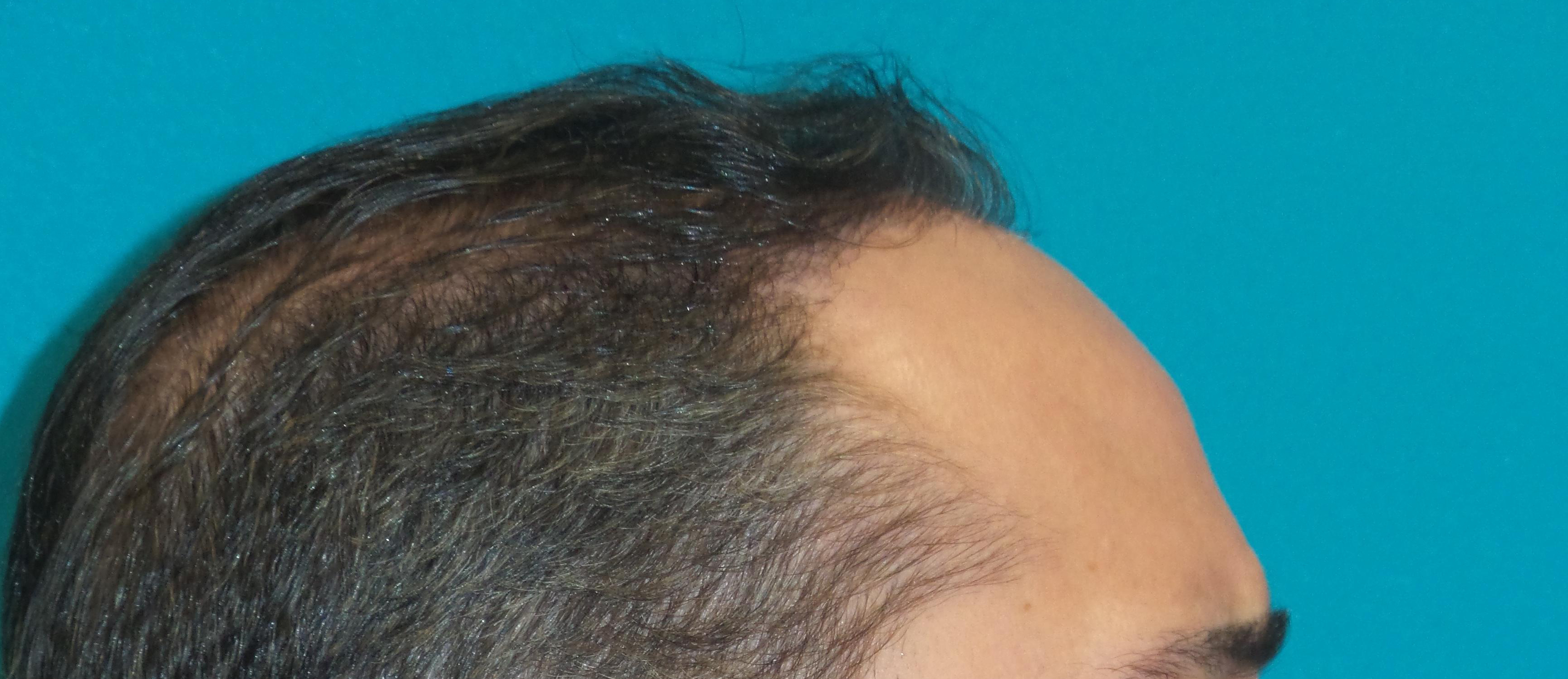 Hair Transplant Before and After | Princeton Plastic Surgeons