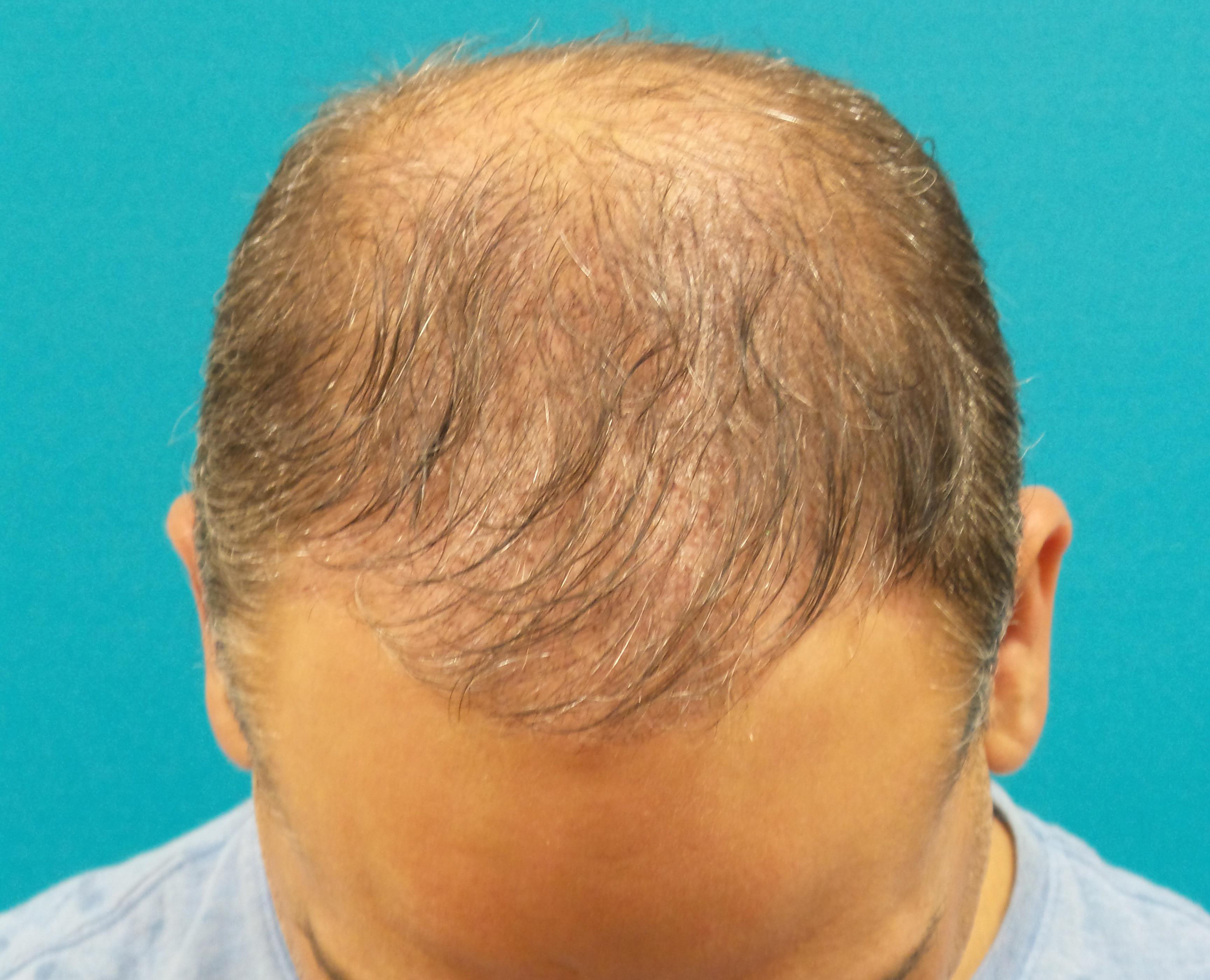 Hair Transplant Before and After | Princeton Plastic Surgeons