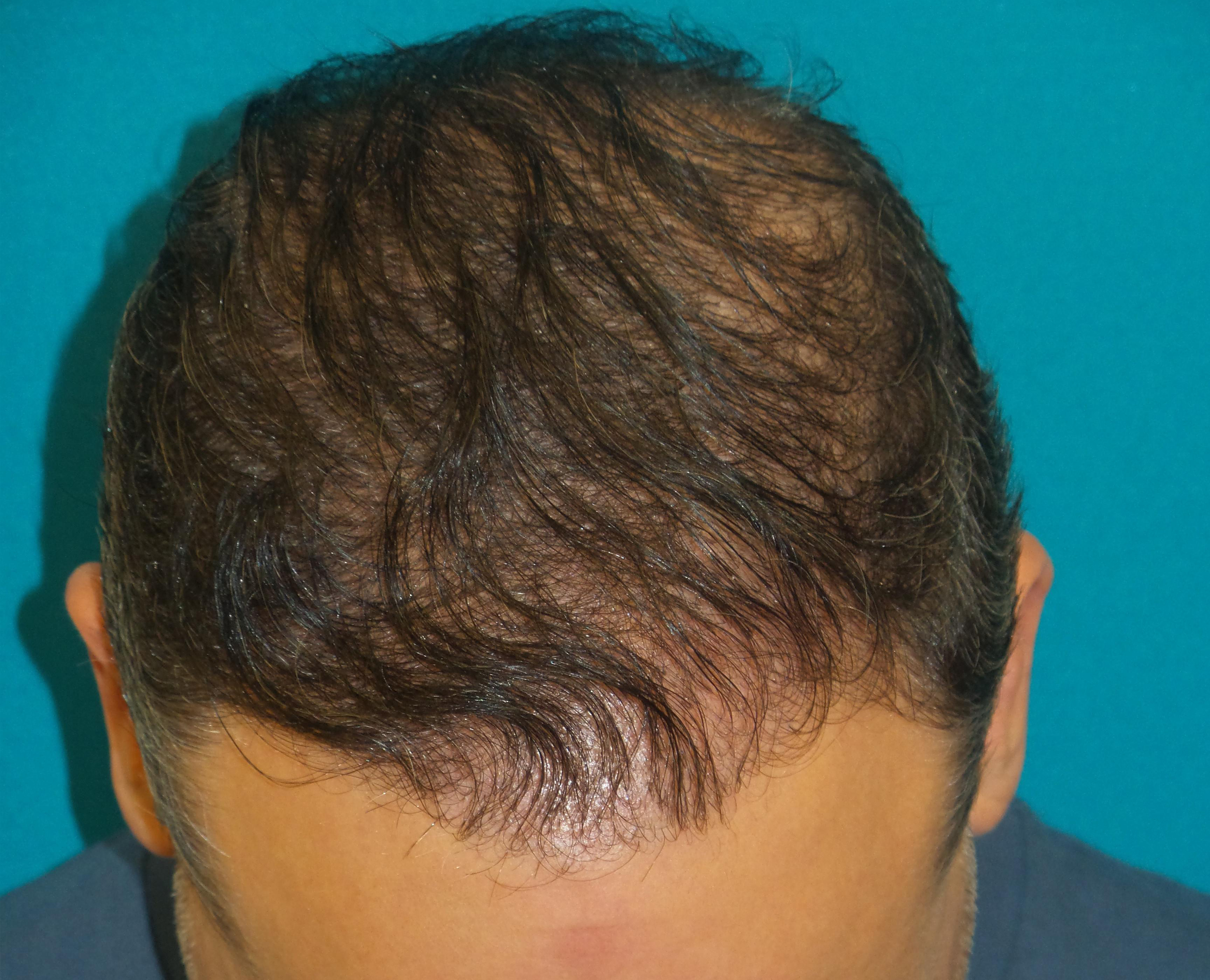 Hair Transplant Before and After | Princeton Plastic Surgeons