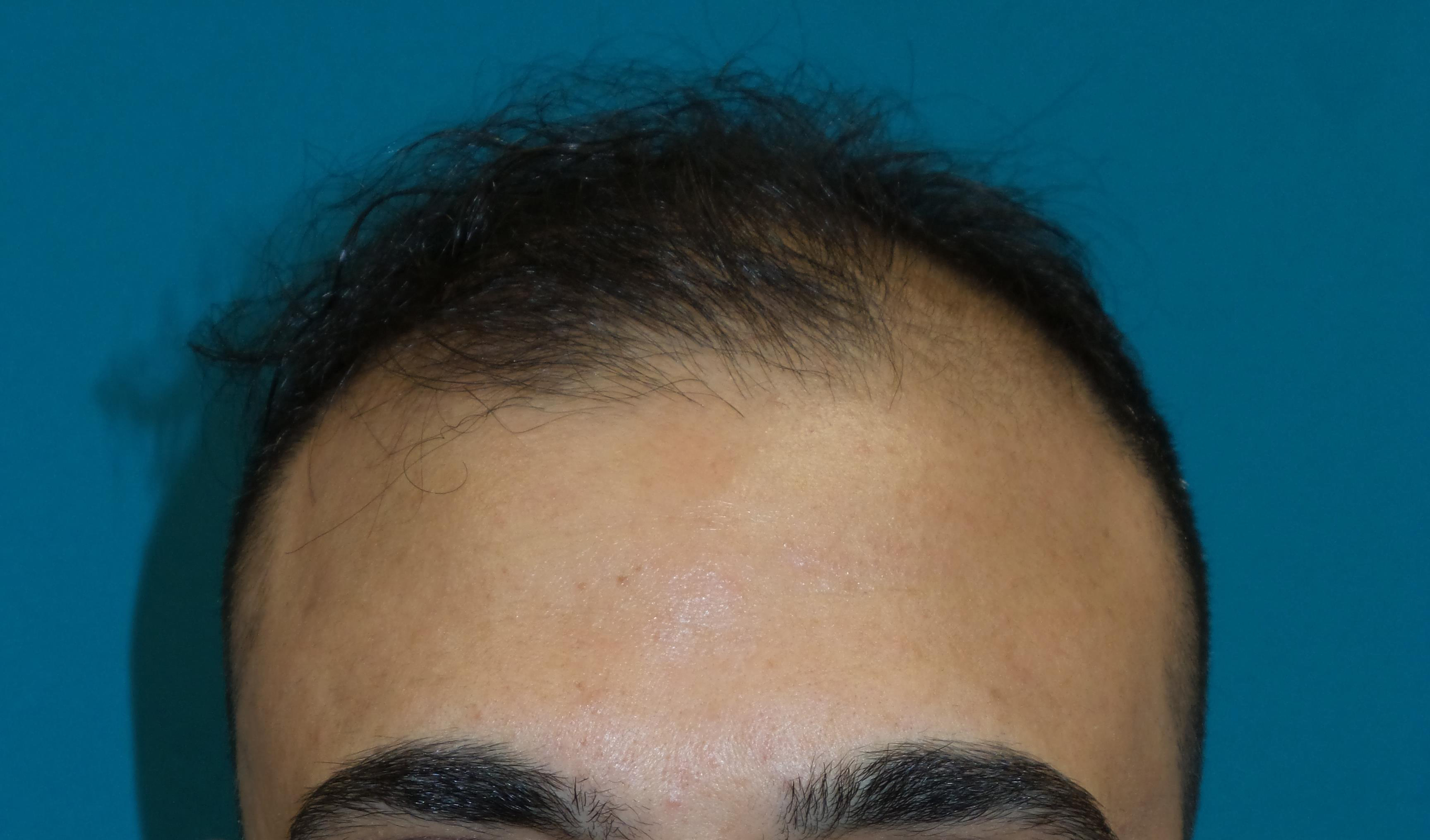 Hair Transplant Before and After | Princeton Plastic Surgeons