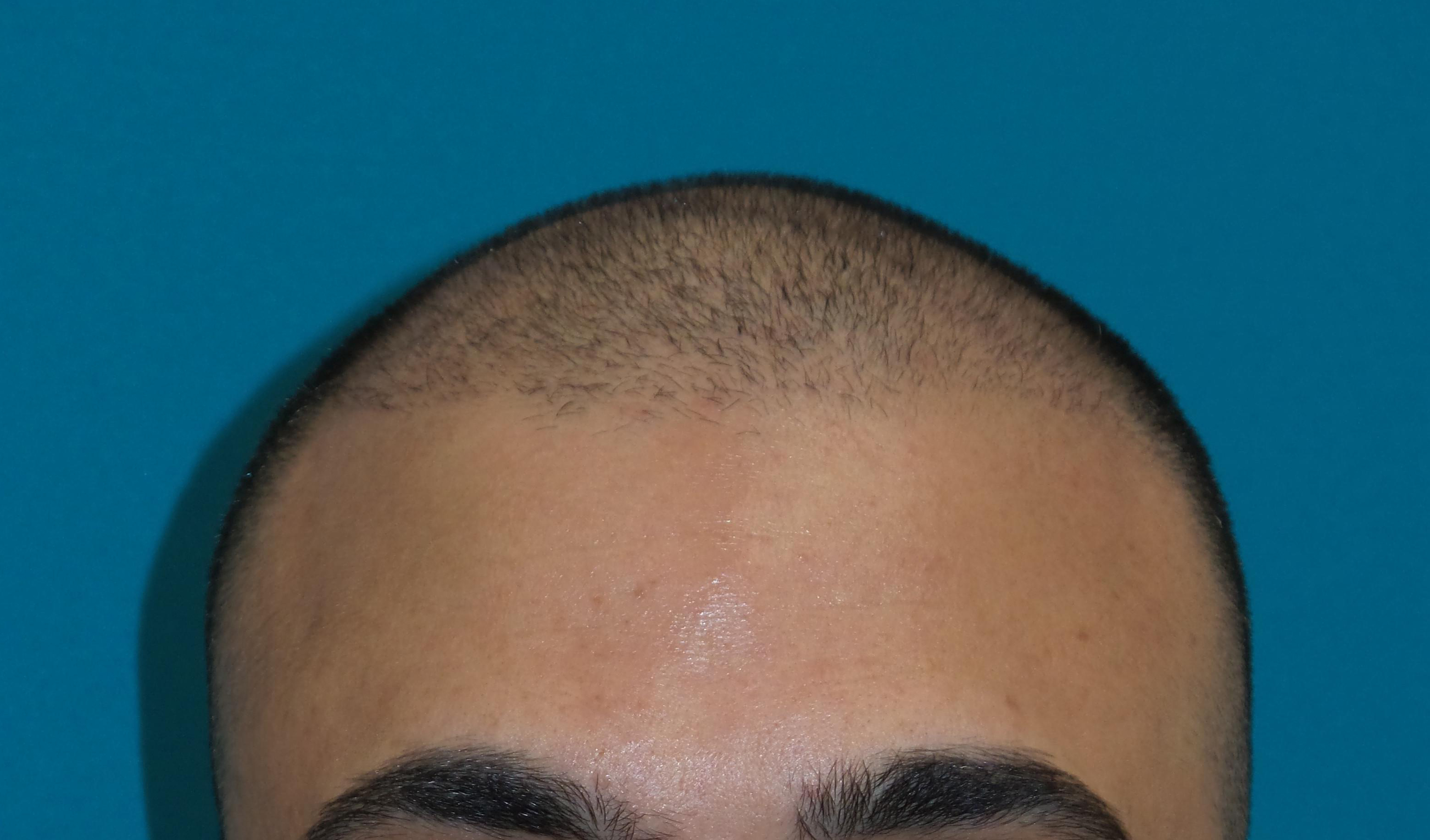 Hair Transplant Before and After | Princeton Plastic Surgeons