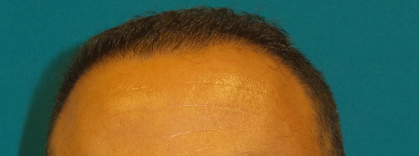 Hair Transplant Before and After | Princeton Plastic Surgeons