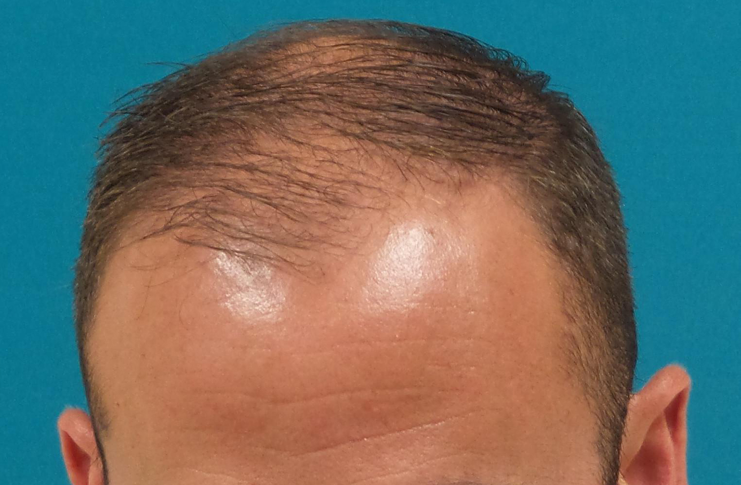 Hair Transplant Before and After | Princeton Plastic Surgeons