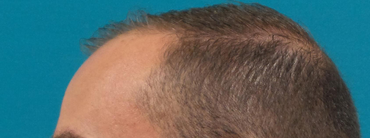 Hair Transplant Before and After | Princeton Plastic Surgeons