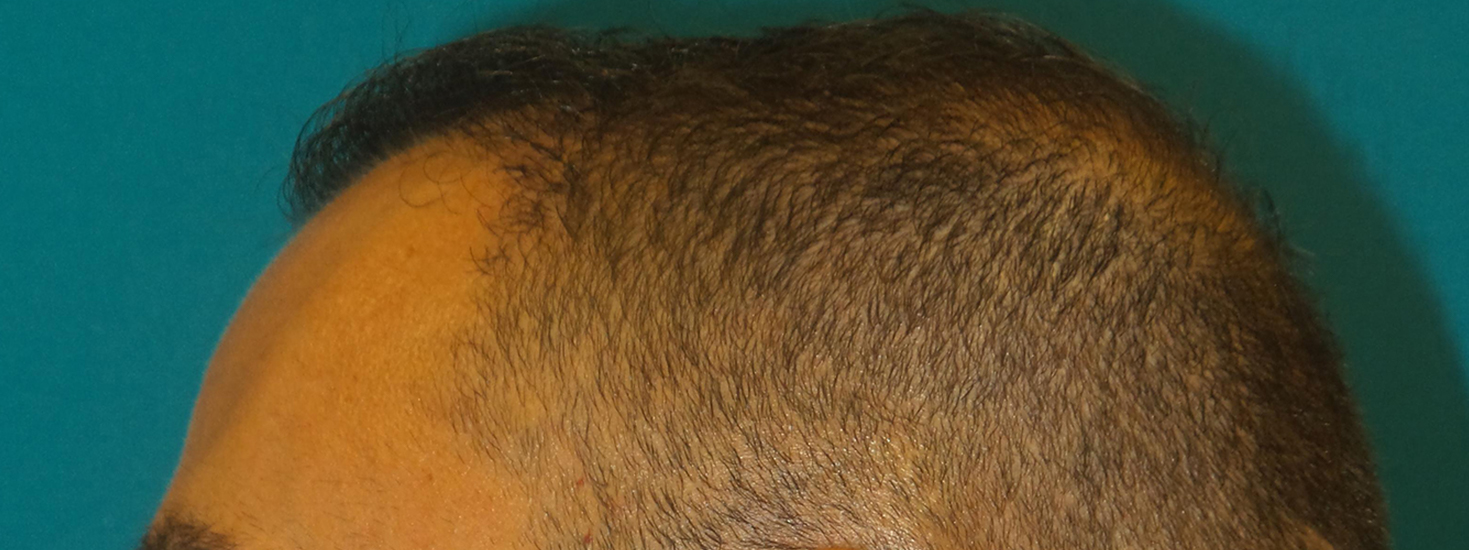 Hair Transplant Before and After | Princeton Plastic Surgeons