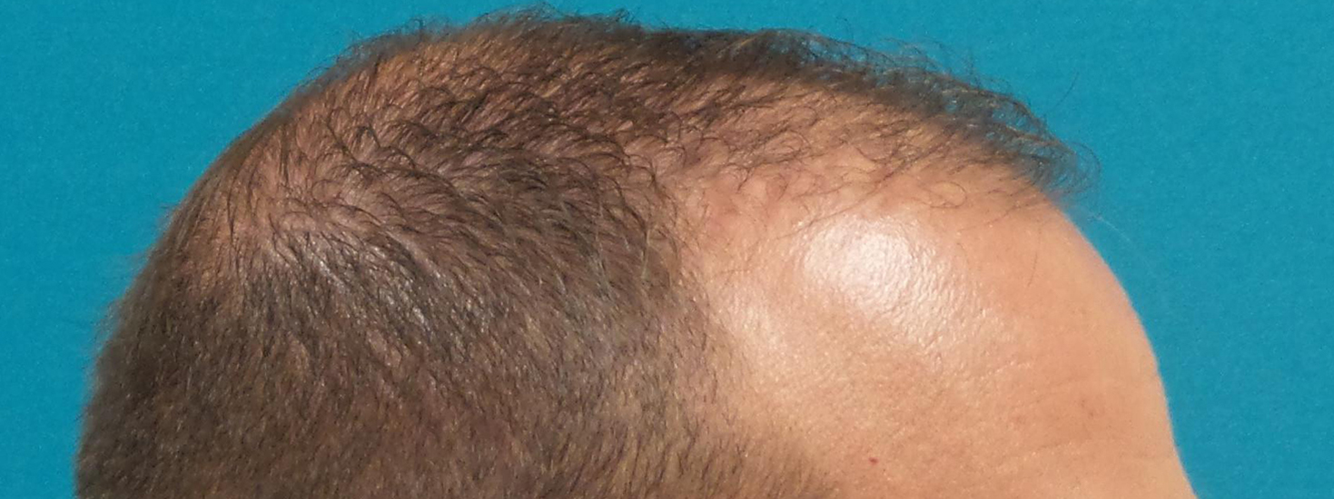 Hair Transplant Before and After | Princeton Plastic Surgeons