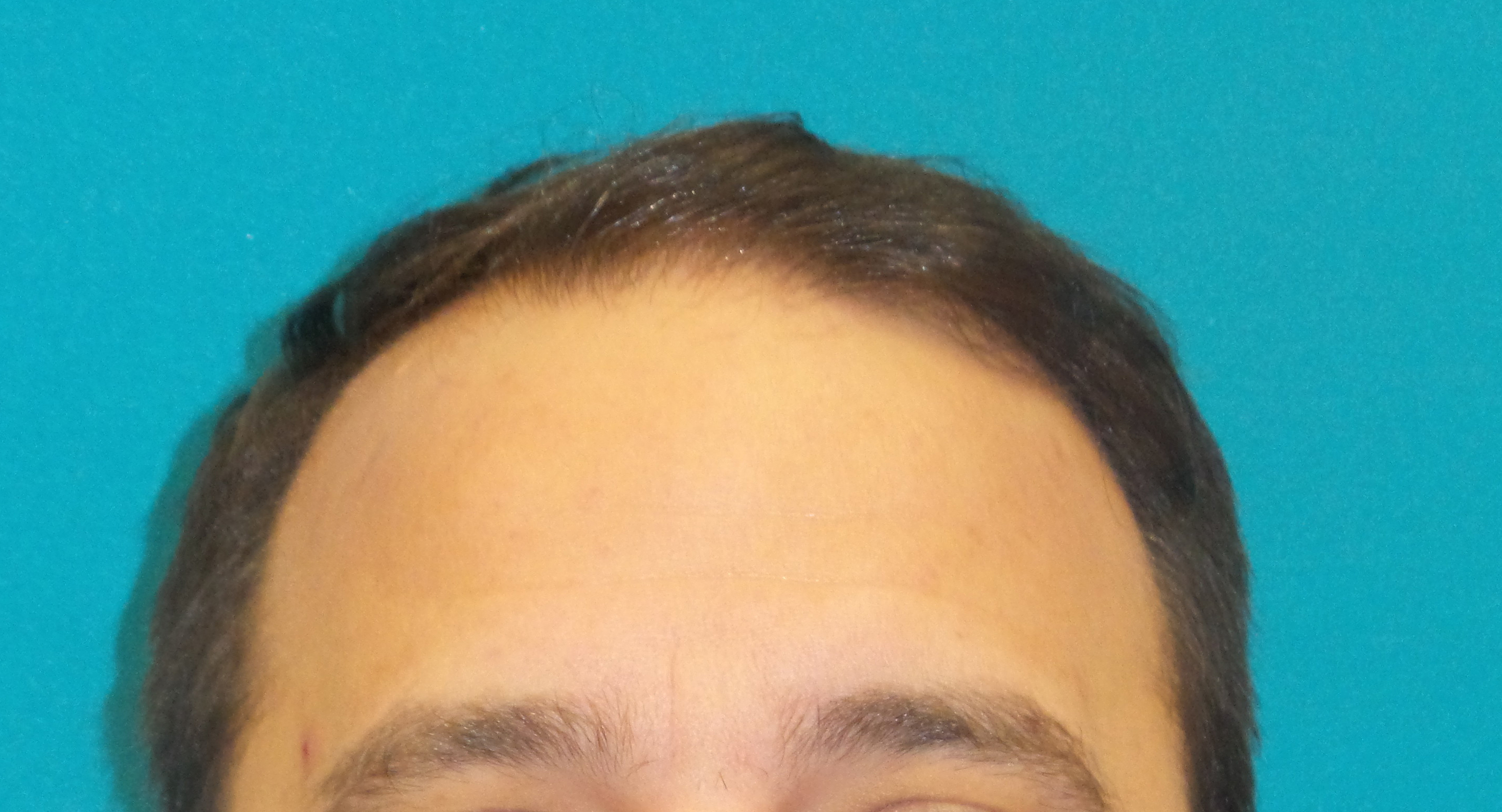 Hair Transplant Before and After | Princeton Plastic Surgeons