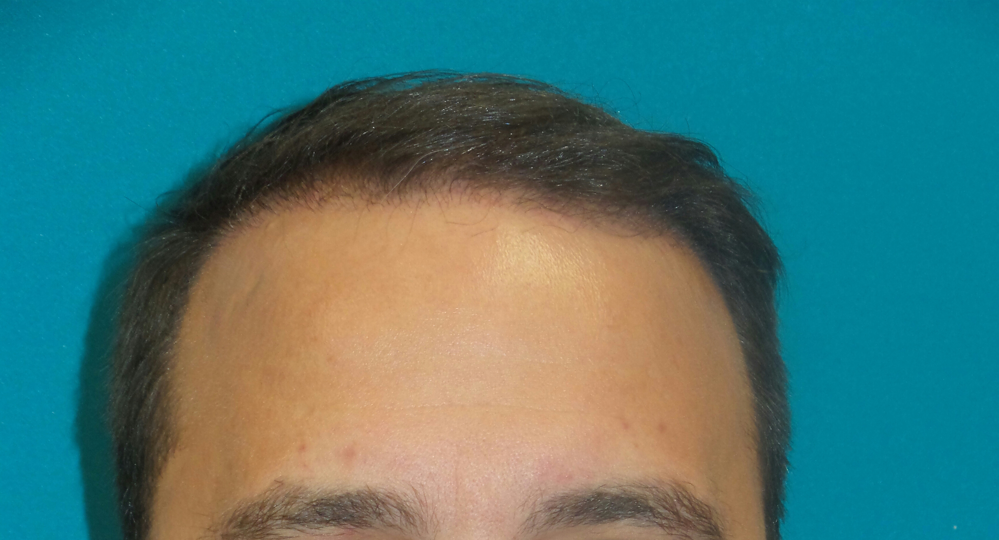 Hair Transplant Before and After | Princeton Plastic Surgeons