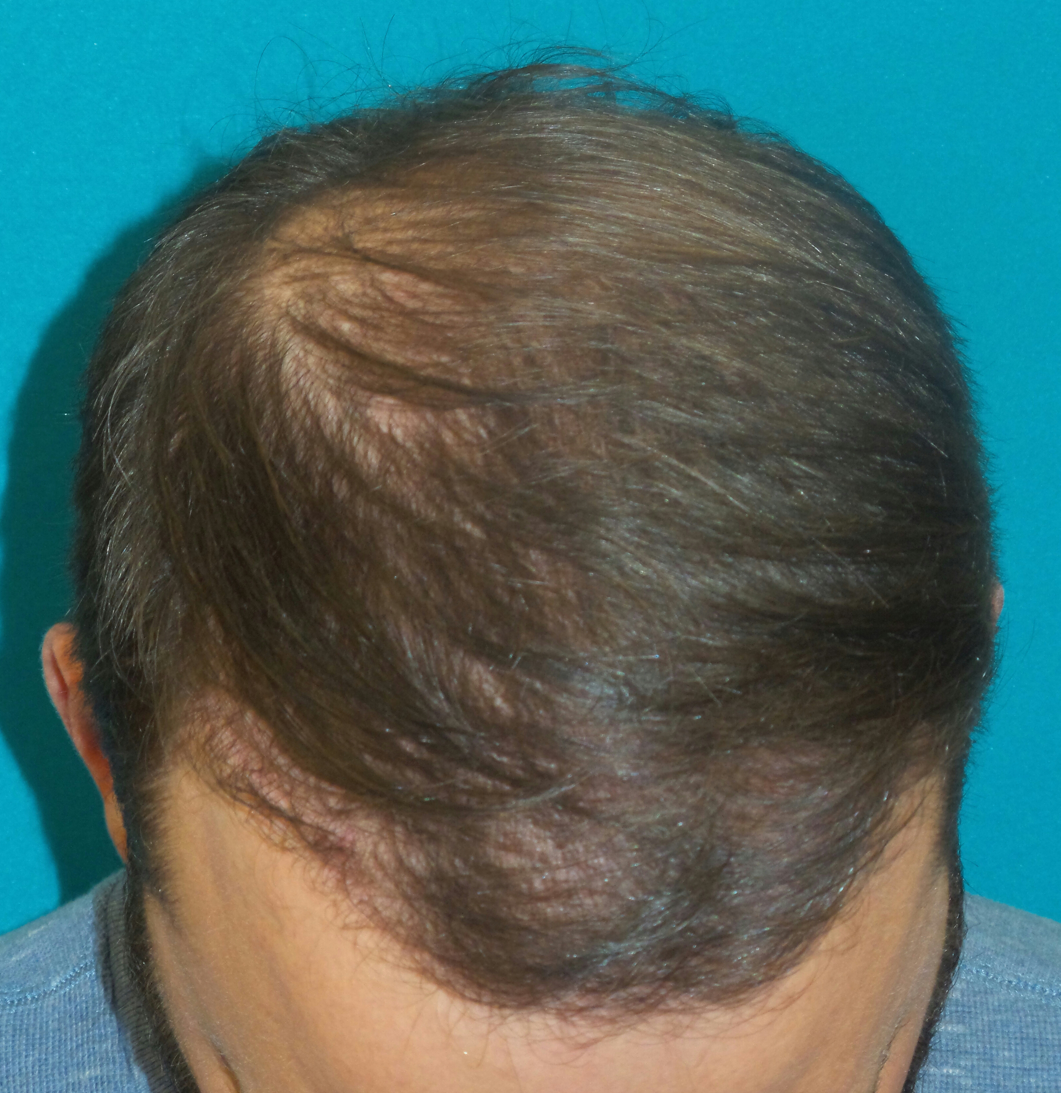 Hair Transplant Before and After | Princeton Plastic Surgeons