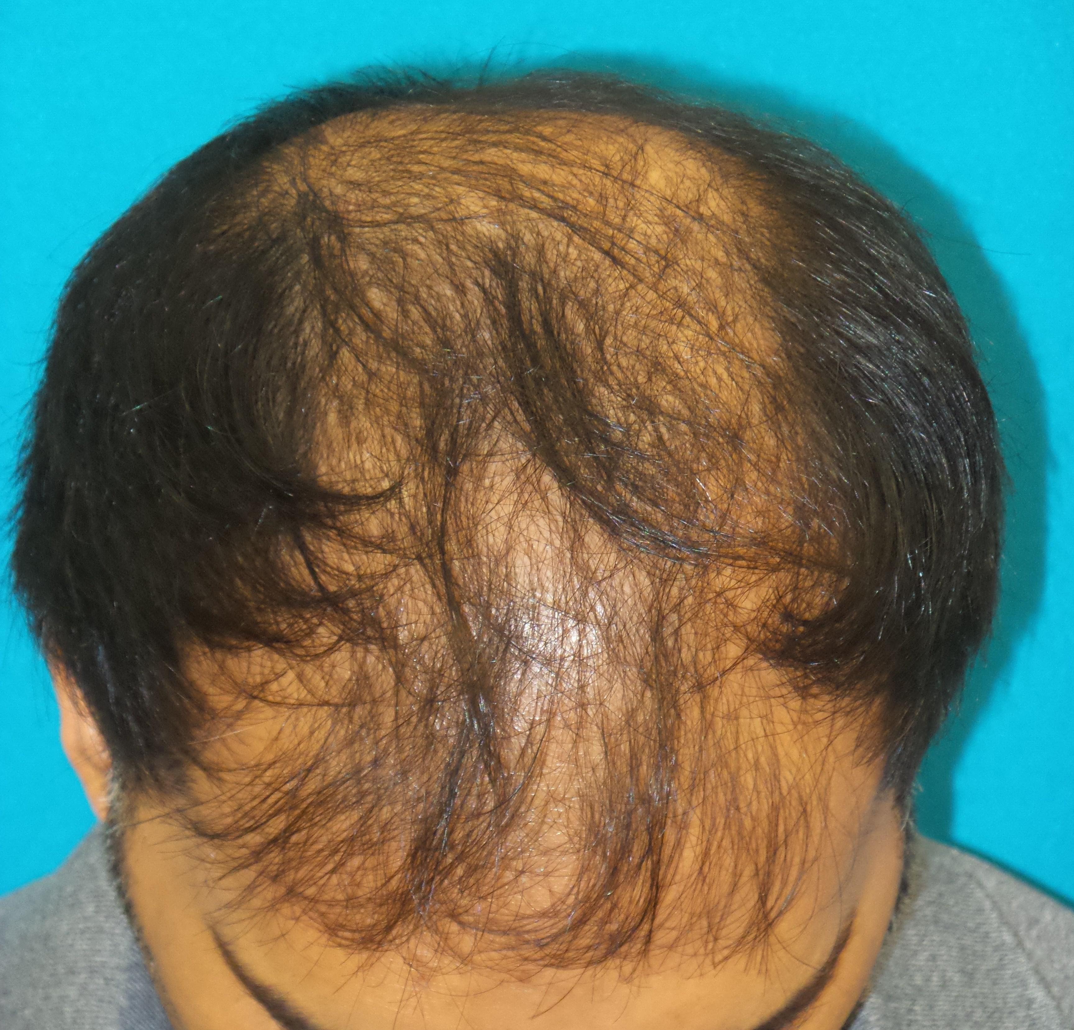 Hair Transplant Before and After | Princeton Plastic Surgeons