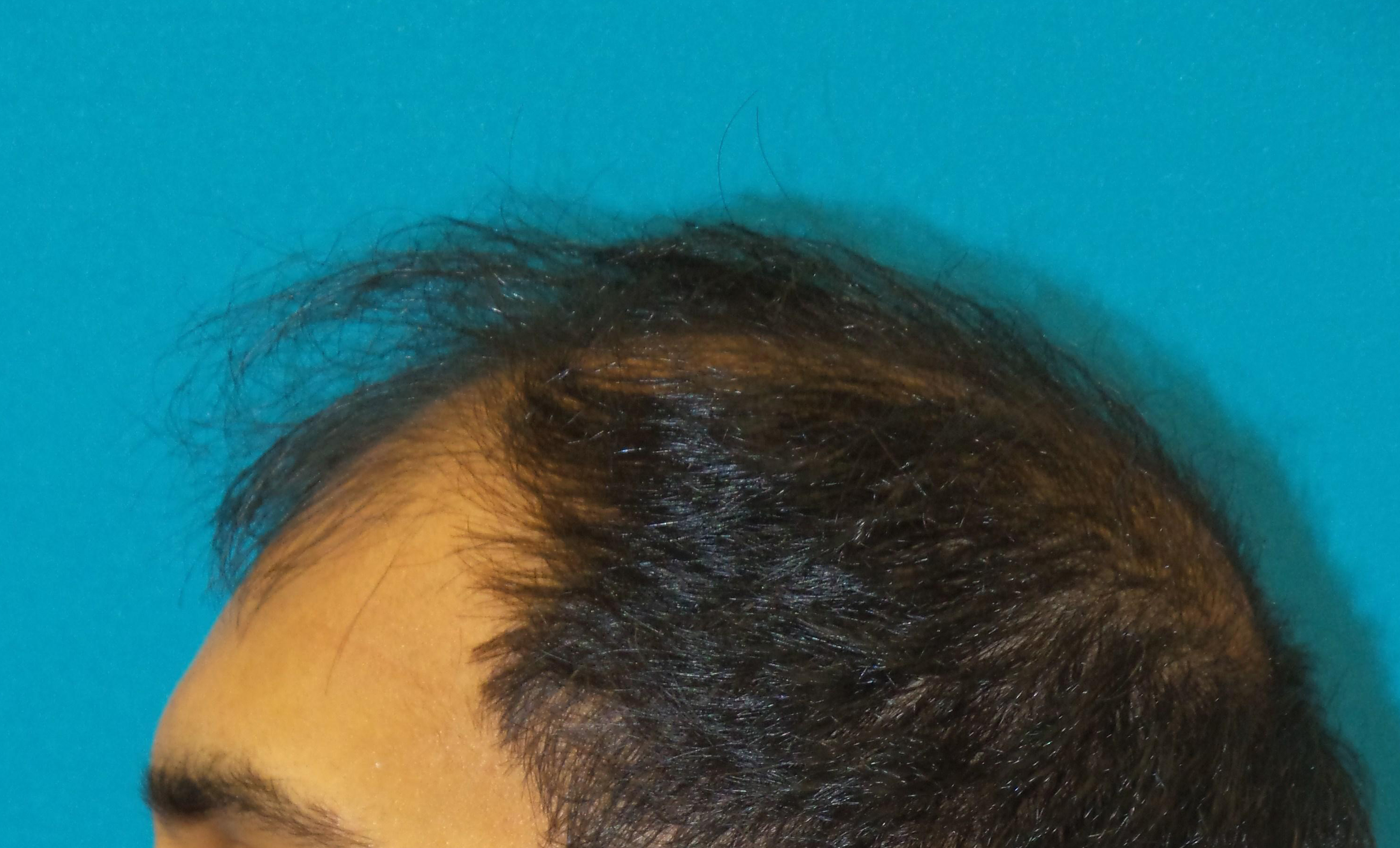 Hair Transplant Before and After | Princeton Plastic Surgeons