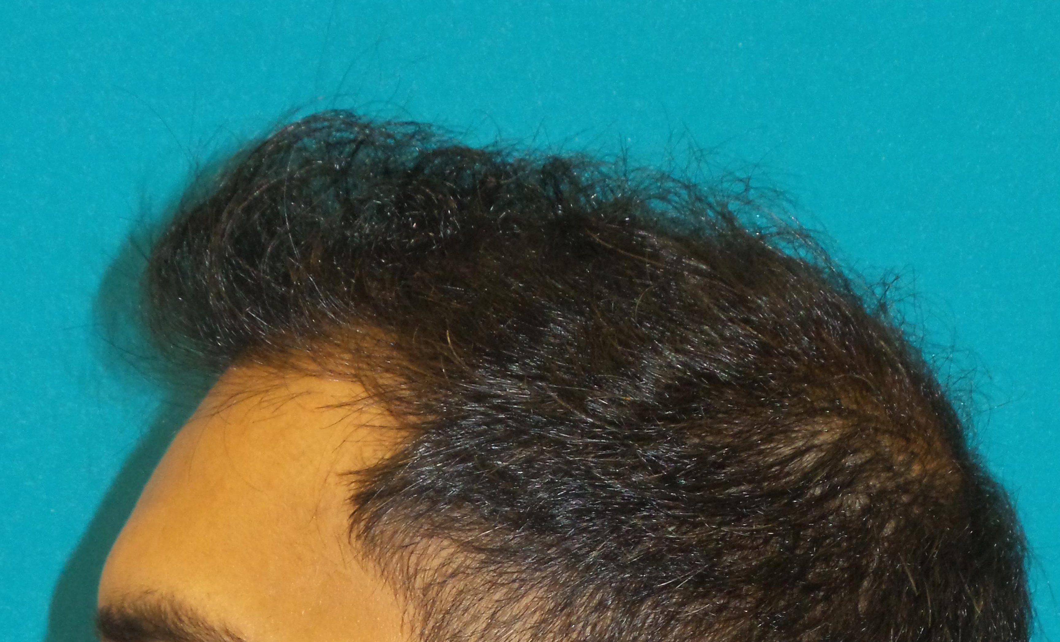 Hair Transplant Before and After | Princeton Plastic Surgeons