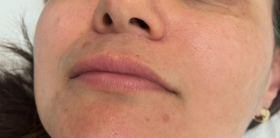 Lip Filler Before and After | Princeton Plastic Surgeons