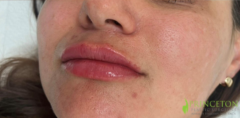 Lip Filler Before and After | Princeton Plastic Surgeons