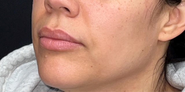 Lip Filler Before and After | Princeton Plastic Surgeons