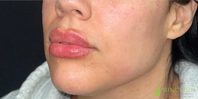 Lip Filler Before and After | Princeton Plastic Surgeons