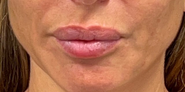 Lip Filler Before and After | Princeton Plastic Surgeons