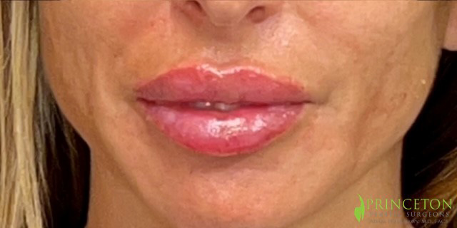 Lip Filler Before and After | Princeton Plastic Surgeons