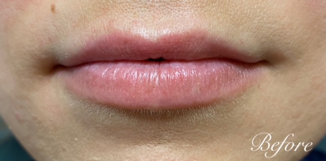 Lip Filler Before and After | Princeton Plastic Surgeons