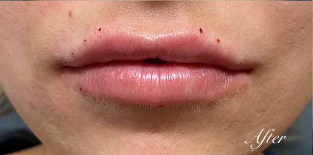 Lip Filler Before and After | Princeton Plastic Surgeons