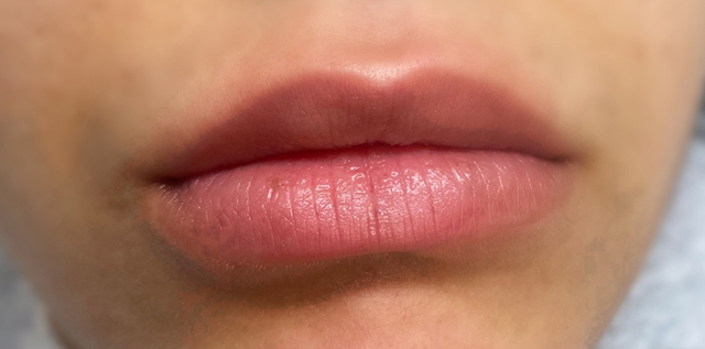 Lip Filler Before and After | Princeton Plastic Surgeons