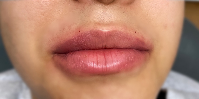 Lip Filler Before and After | Princeton Plastic Surgeons