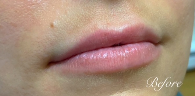 Lip Filler Before and After | Princeton Plastic Surgeons