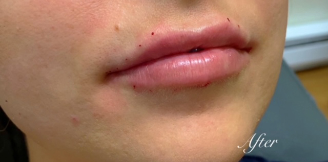 Lip Filler Before and After | Princeton Plastic Surgeons