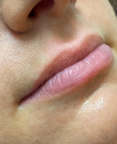 Lip Filler Before and After | Princeton Plastic Surgeons