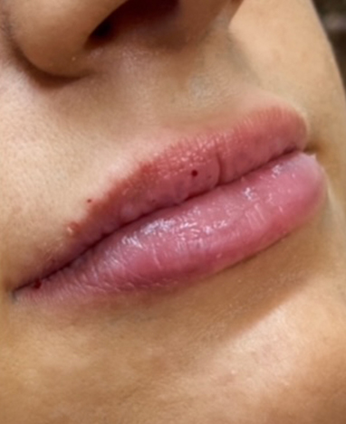 Lip Filler Before and After | Princeton Plastic Surgeons