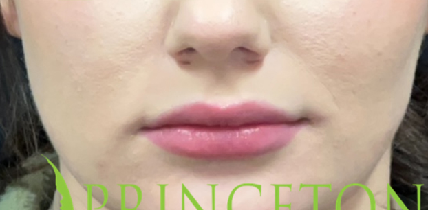 Lip Filler Before and After | Princeton Plastic Surgeons