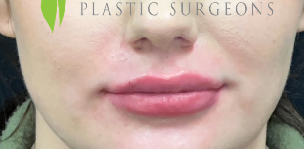 Lip Filler Before and After | Princeton Plastic Surgeons