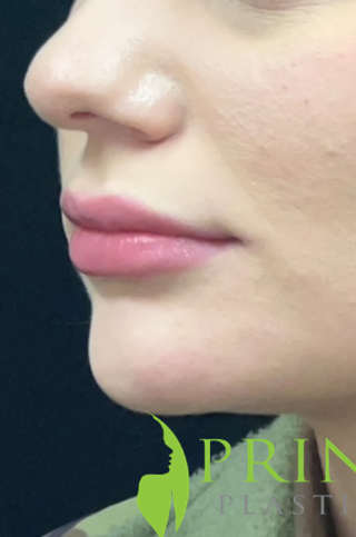 Lip Filler Before and After | Princeton Plastic Surgeons