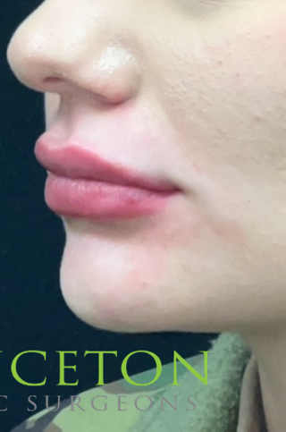 Lip Filler Before and After | Princeton Plastic Surgeons