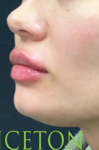 Lip Filler Before and After | Princeton Plastic Surgeons