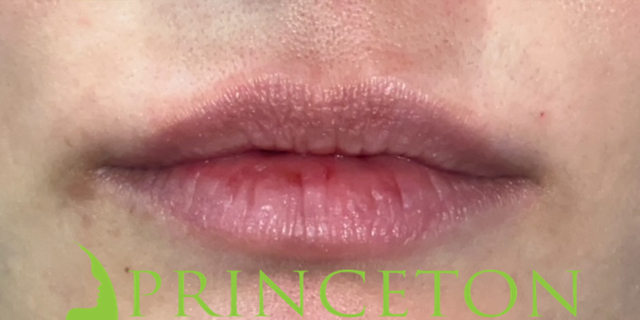 Lip Filler Before and After | Princeton Plastic Surgeons