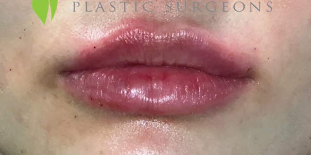 Lip Filler Before and After | Princeton Plastic Surgeons