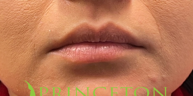 Lip Filler Before and After | Princeton Plastic Surgeons
