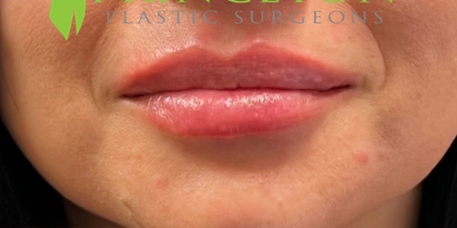 Lip Filler Before and After | Princeton Plastic Surgeons