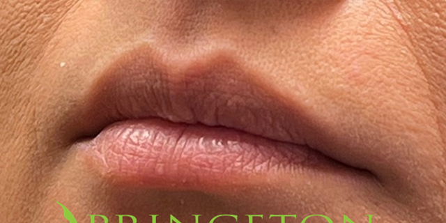 Lip Filler Before and After | Princeton Plastic Surgeons