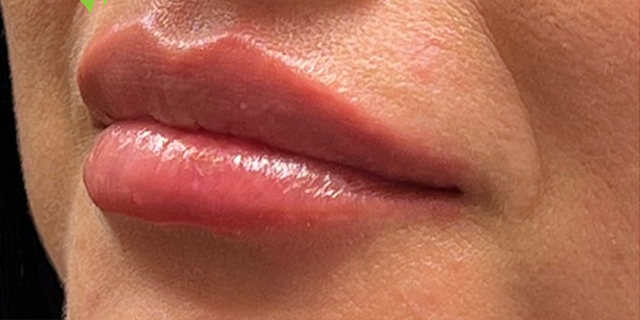 Lip Filler Before and After | Princeton Plastic Surgeons