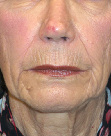 Lip Lift Before and After | Princeton Plastic Surgeons