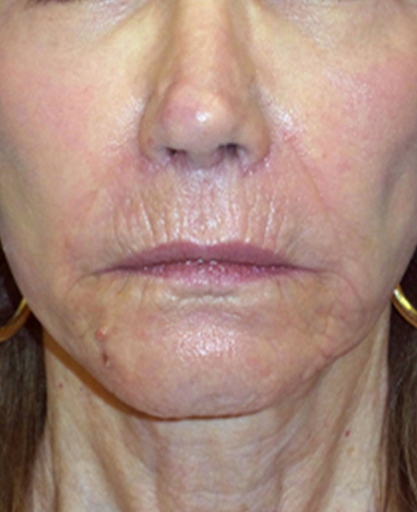 Lip Lift Before and After | Princeton Plastic Surgeons