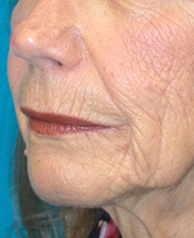 Lip Lift Before and After | Princeton Plastic Surgeons