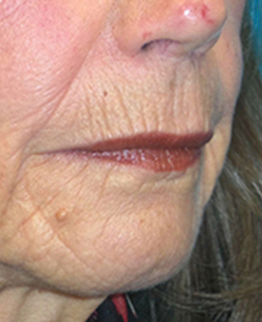 Lip Lift Before and After | Princeton Plastic Surgeons